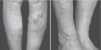  ??  ?? A MATHE SECRET TO LEG AND FOOT RELIEF IS FOUND RIGHT BELOW THE SKIN, ACCORDING TO NEW RESEARCH: Diabasens increases sensation and blood flow wherever its applied. It’s now being used to relieve burning, tingling, numbness among other discomfort­s.