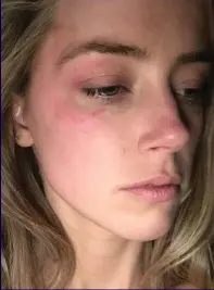  ??  ?? Battered: Amber Heard shows off her bruises