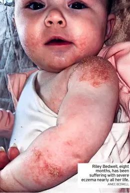  ?? AIMEE BEDWELL ?? Riley Bedwell, eight months, has been suffering with severe eczema nearly all her life.