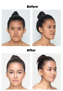  ??  ?? Forehead lifting
Facial contour correction
Rhinoplast­y
Ophtalmopl­asty
Otoplasty
Middle facial lifting
Rejuvenati­on by stem cells