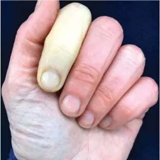  ??  ?? Pain: The picture she shared of her whitened finger, caused by Raynaud’s