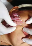  ??  ?? A thin needle is used to insert the sutures under facial tissues.