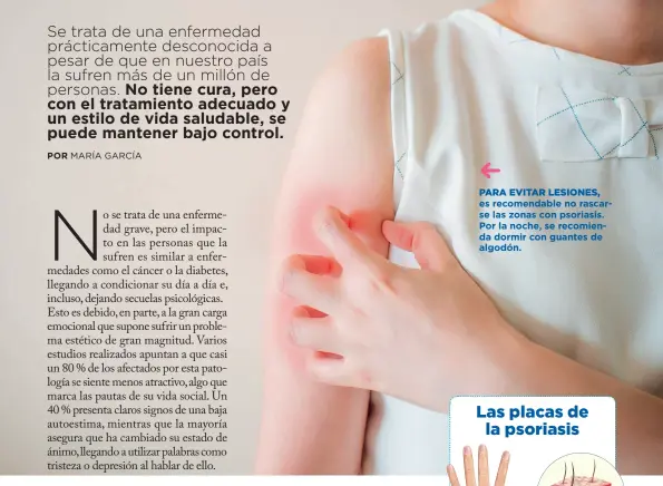  ??  ?? PARA EVITAR LESIONES, es recomendab­le no rascarse las zonas con psoriasis. Por la noche, se recomienda dormir con guantes de algodón.