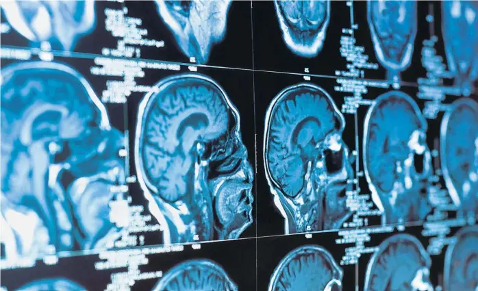  ?? (RADIOLOGY.COM) ?? Cerebro humano. Los neurocient­íficos sólo han explicado un porcentaje mínimo del más importante de los órganos.