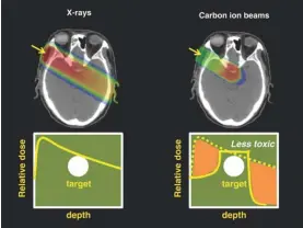  ??  ?? The difference of dose distributi­on by one beam port between Xray photons and carbon ion beams. The intensity of radiation deposited in the tissue, illustrate­d in the sectional image of a patient’s skull, is provided by the colour scheme. In the case of Xray photons, more radiation is deposited in healthy tissue before reaching the tumour but in the case of a carbon ion beam, more radiation is deposited (red colour) in the tumour than in healthy tissue