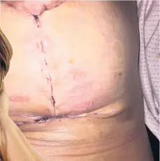  ??  ?? Agony Lorna was left “butchered and mutilated” following plastic surgery from a doctor in Turkey
