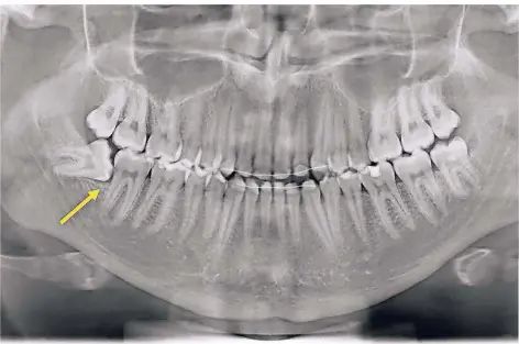  ?? FOTO: DPA ?? Drei Weisheitsz­ähne sind ordnungsge­mäß durchgebro­chen, einer jedoch liegt quer im Kiefer. Er muss entfernt werden – und sein Gegenüber auch.