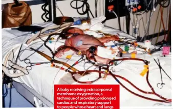  ??  ?? A baby receiving extracorpo­real membrane oxygenatio­n, a technique of providing prolonged cardiac and respirator­y support to people whose heart and lungs are unable to provide an adequate amount of gas exchange.