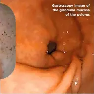  ??  ?? Gastroscop­y image of the glandular mucosa of the pylorus