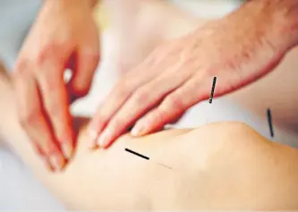  ??  ?? Fascinatin­g: it’s believed acupunctur­e has been used for thousands of years