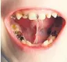  ??  ?? BLACK MARK Rotten teeth