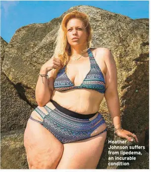  ??  ?? Heather Johnson suffers from lipedema, an incurable condition