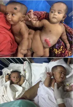  ??  ?? This combinatio­n image of two file photos taken on August 2017 shows conjoined Bangladesh­i twins Tofa and Tahura before (top) and after surgery (bottom) to separate them at Dhaka Medical College Hospital. — AFP photo