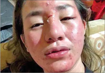  ?? PHOTO SUPPLIED ?? A photo of actor Pich Aviza, that has been circulated on social media, after she was allegedly beaten at a Phnom Penh Bar on Sunday.