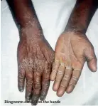  ??  ?? Ringworm disease on the hands