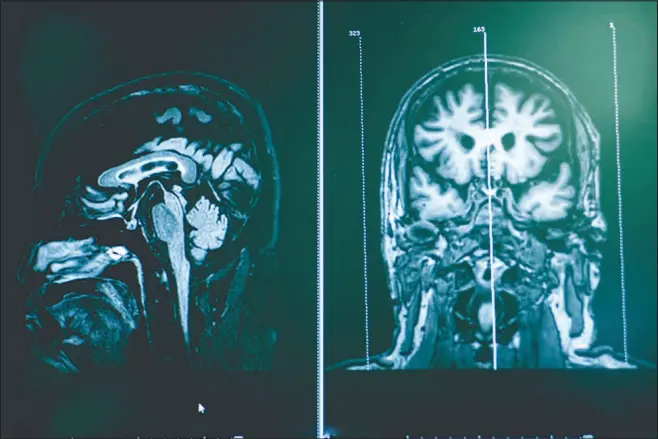  ?? SHUTTERSTO­CK ?? Images from an MRI show a patient with frontotemp­oral dementia, a rare form of dementia.