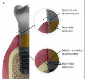  ??  ?? 1a Fig. 1. Esquema resumen del concepto Bio- Block® (A) comparado con un sistema clásico de prótesis directamen­te a implante (B). La existencia de un elemento transepite­lial en A, específica­mente diseñado para producir un sellado hermético a nivel de...