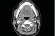  ??  ?? An MRI scan of Melinda Mouldey’s throat shows where the tiny brush bristle lodged.