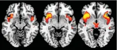  ??  ?? Les régions activées lors d’une hallucinat­ion auditive apparaisse­nt sur cette séquence d’images IRM. Tout se déroule comme si la personne entendait réellement un son.