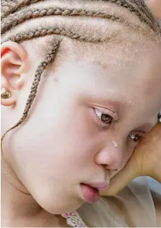  ?? Foto: Wolfgang Kumm/dpa ?? Mit Tränen in den Augen ein Albinokind in Abuja, Nigeria. In vielen Ländern Afrikas werden Menschen mit dem Gendefekt verfolgt.