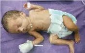  ??  ?? The 700-gram baby was referred to AIIMS from Rohtak after she was diagnosed with a disease called esophageal atresia