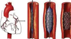  ??  ?? STEN angioplast­i diguna untuk buka saluran darah tersumbat.