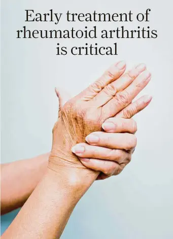  ?? Getty Images ?? Symptoms of rheumatoid arthritis begin slowly, with joint pain and stiffness, especially in the morning, which might be mistaken for osteoarthr­itis.