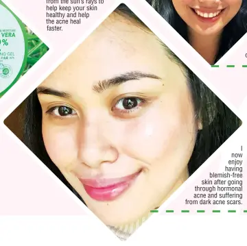  ??  ?? I now enjoy having blemish-free skin after going through hormonal acne and suffering from dark acne scars.