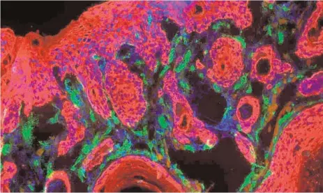  ?? ABC ?? Tumor al microscopi­o de un ratón donde se muestran las células tumorales (en rojo)