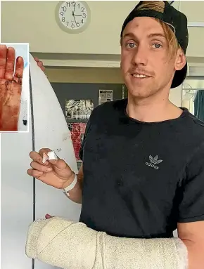 ??  ?? Andrew "Nugget" Brough, 25, got a fright when his cast came off, revealing the damage of a great white shark attack.