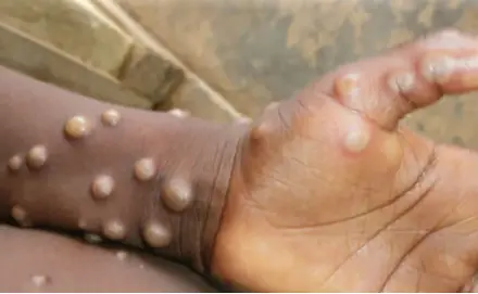  ?? ?? Mpox spreads through direct contact with the Mpox virus through blood, bodily fluids and skin or mucous lesions.