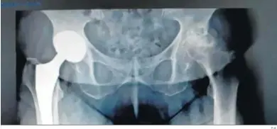  ?? D.A. ?? Radiografí­a de una prótesis total de cadera.