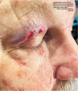  ?? PHOTO / SUPPLIED / GABRIELLE WILDBORE ?? Auckland bus driver David Bahler’s eyes were targeted in one attack, then his head was stomped weeks later.