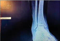  ?? Courtesy photo ?? X-ray of Jamie Ash’s broken ankle. She was an experience­d hiker who was injured in the backcountr­y north of Taos.