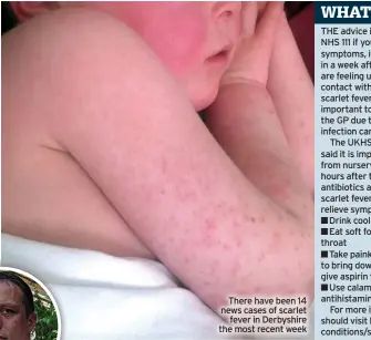  ?? ?? There have been 14 news cases of scarlet fever in Derbyshire the most recent week
