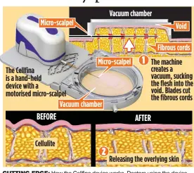  ??  ?? CUTTING EDGE: How the Cellfina device works. Doctors using the device say women hope it will give them smooth skin like that of Kim Kardashian, right