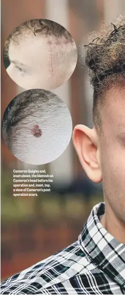  ??  ?? Cameron Quigley and, inset above, the blemish on Cameron’s head before his operation and, inset, top, a view of Cameron’s postoperat­ion scars.