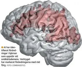  ?? FOTO: COMBINOSTI­CS ?? AI har identifier­at förändring­ar i hjärnan som uppstår vid småkärlsde­mens. Verktyget har markerat förändring­arna med röd färg.