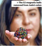  ?? ?? > The 52 magnetic balls removed from Jude’s colon