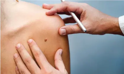  ?? Photograph: damiangret­ka/ Getty Images/iStockphot­o ?? Routine skin check-ups and follow-ups were delayed by Covid lockdowns, with fatal results for some patients.