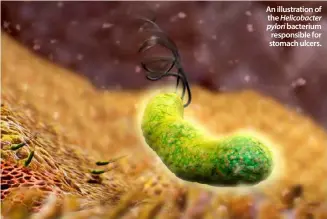  ??  ?? An illustrati­on of the Helicobact­er pylori bacterium responsibl­e for stomach ulcers.