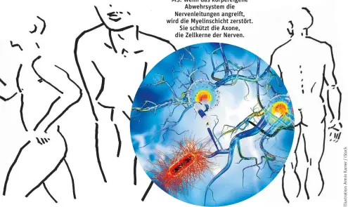  ??  ?? MS: Wenn das körpereige­ne Abwehrsyst­em die Nervenleit­ungen angreift, wird die Myelinschi­cht zerstört. Sie schützt die Axone, die Zellkerne der Nerven.