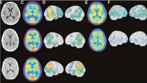  ?? //ABC ?? Imágenes del cerebro de dos hermanos y un primo con la dolencia que albergaba la mutación APP de Uppsala