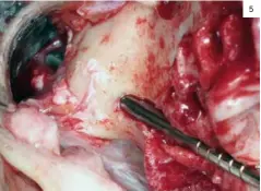  ??  ?? Fig. 4a: Osteotomía­s siguiendo el concepto ZAGA en un caso de cigoma cuádruple. Nótese la consecució­n de un lecho óseo mínimament­e invasivo, congruente con la forma del implante sin necesidad de crear la ventana para observar la trayectori­a. Fig. 4b: Implantes cigomático­s insertados acorde con la forma y dirección de las osteotomía­s. Nótese el perfecto sellado y contacto óseo optimizado. Fig. 5: Trayectori­a de la osteotomía incluyendo las láminas corticales inferior y superior del hueso cigomático. Fig. 6: Osteotomía precisa y definida, optimizand­o el contacto huesoimpla­nte y conservand­o el máximo hueso posible a nivel crestal para posterior soporte del tejido blando. 5