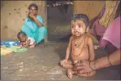  ??  ?? One of Palghar’s malnourish­ed kids.