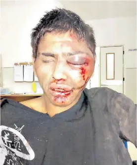  ??  ?? Heridas. El joven golpeado fue detenido y tuvo que ser internado.