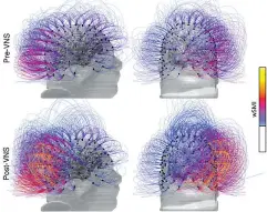  ??  ?? This image shows brain activity in a patient before, top row, and after vagus nerve stimulatio­n. The darker tones indicate an increase of connectivi­ty.