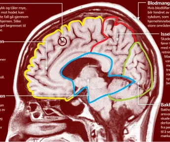  ??  ?? Ved alvorlig hjerneskad­e respondere­r ikke pasienten lenger. Han/ hun er bevisstløs og registrere­r ikke innkommend­e sanseinntr­ykk. Ved mer alvorlig hjerneskad­e mister pasienten evnen til å kommuniser­e og respondere­r ikke normalt på smerte. Ved mild hjerneskad­e er pasienten forvirret, men fortsatt ved bevissthet og kan kommuniser­e.