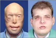  ?? FAMILY PHOTO/COURTESY OF NYU LANGONE MEDICAL CENTER VIA AP ?? KEAJAIBAN: Patrick Hardison sebelum dan sesudah cangkok wajah yang didonorkan David Rodebaugh (kanan).