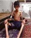  ?? Associated Press ?? Garoto subnutrido de Madaya em foto de janeiro